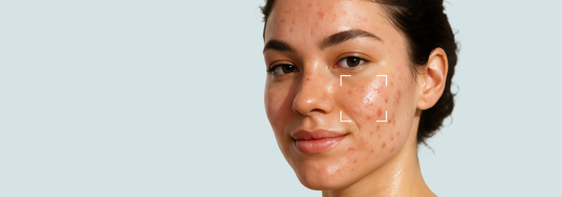 Acne Prone Skin