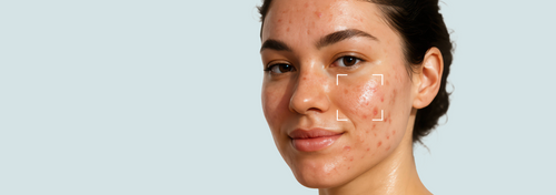 Acne Prone Skin