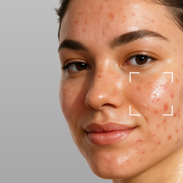 Acne-Prone